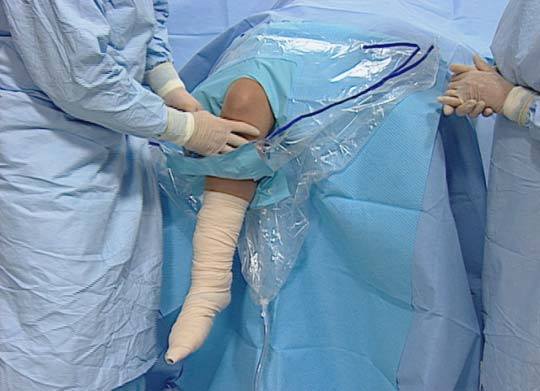 Sterile Knee Arthroscopy Drape